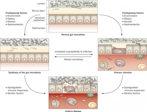 Crohns_Model